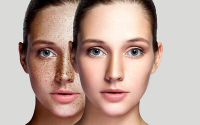 How to Remove Dark Spots on Face with Vitaric Glutathione Serum